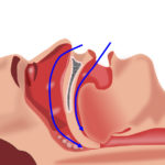 How I Made My Husband Stop Snoring